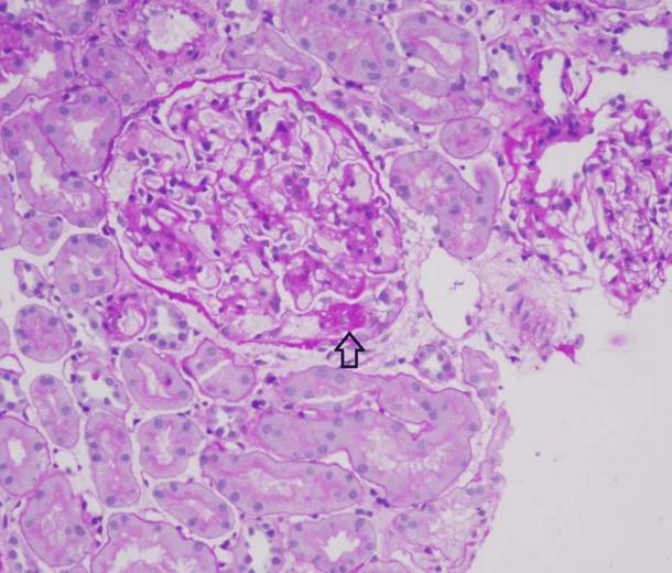 Nierenbiopsie in PAS-Färbung: ein Glomerulus mit überwiegend erhaltenen Kapillarschlingen; ein Pfeil markiert am Gefäßpol einen kleinen vernarbten Abschnitt mit Verklebung zur Bowman-Kapsel. Rundherum Tubuli.