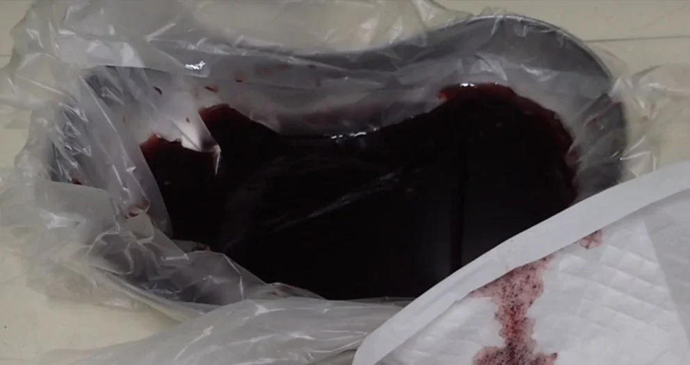 Auffangschale mit Plastikbeutel: darin eine große Menge dunkelroter, geronnener Blutkoagel; rechts eine Unterlage mit Blutspuren.