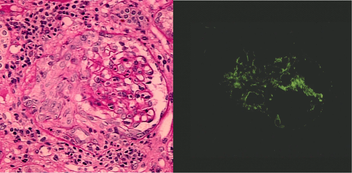 Links ein Glomerulus in PAS-Färbung, dessen Kapillarknäuel von einem zellreichen, ringförmigen Halbmond im Bowman-Raum umgeben ist; rechts Immunfluoreszenz mit grünen C3-Ablagerungen im Mesangium.