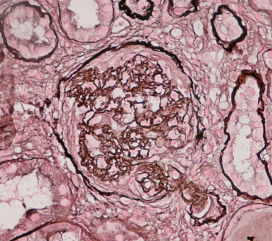 Lichtmikroskopisches Bild eines Glomerulus in Silberfärbung: Das dunkel gefärbte Kapillarknäuel ist zusammengedrückt und von einem breiten zellreichen Halbmond im Bowman-Raum umgeben; ringsum Tubuli.