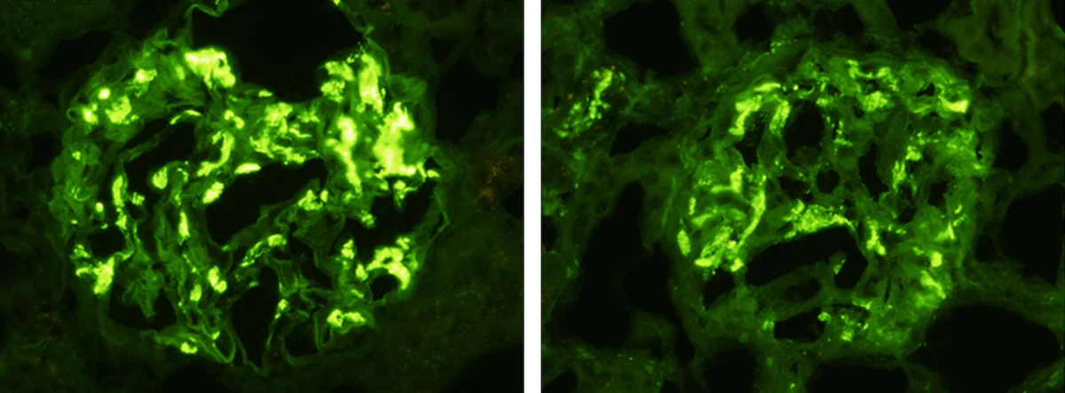 Zwei Immunfluoreszenzaufnahmen desselben Glomerulus-Typs: links leuchtend grüne, fleckige Ablagerungen von IgA im Mesangium, rechts schwächere C3-Ablagerungen im gleichen Verteilungsmuster.