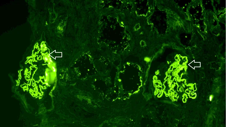 Immunfluoreszenz einer Nierenbiopsie mit zwei Glomeruli: Grün leuchtende IgG-Ablagerungen folgen als feine, durchgehende Linien den Kapillarschlingen; Pfeile markieren die Linien.