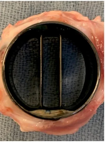 Mechanische Herzklappenprothese mit dunklem Metallring und zwei schmalen Klappenflügeln, ringsum eingewachsenes Gewebe, auf einem blauen Tuch.
