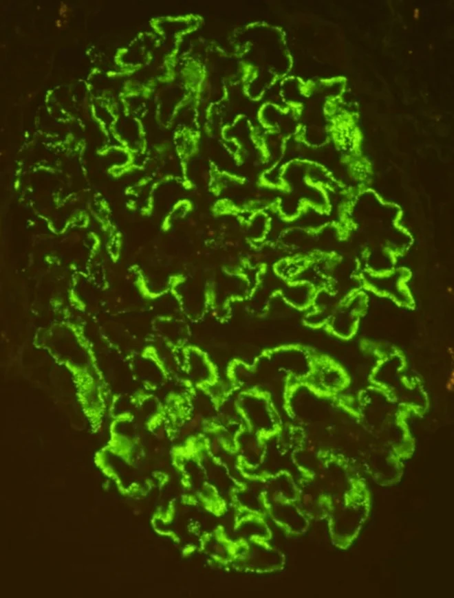 Immunfluoreszenz eines Glomerulus in Grün: feine, körnige Ablagerungen ziehen gleichmäßig entlang aller Kapillarschlingen.