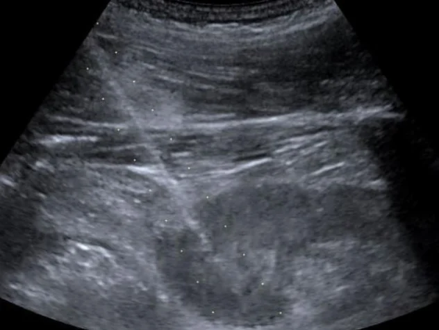 Ultraschallbild der Niere im Längsschnitt: Eine helle, gerade Linie zieht schräg von links oben durch Haut und Muskulatur bis in die Nierenrinde; das ist die Biopsienadel nach dem Auslösen.