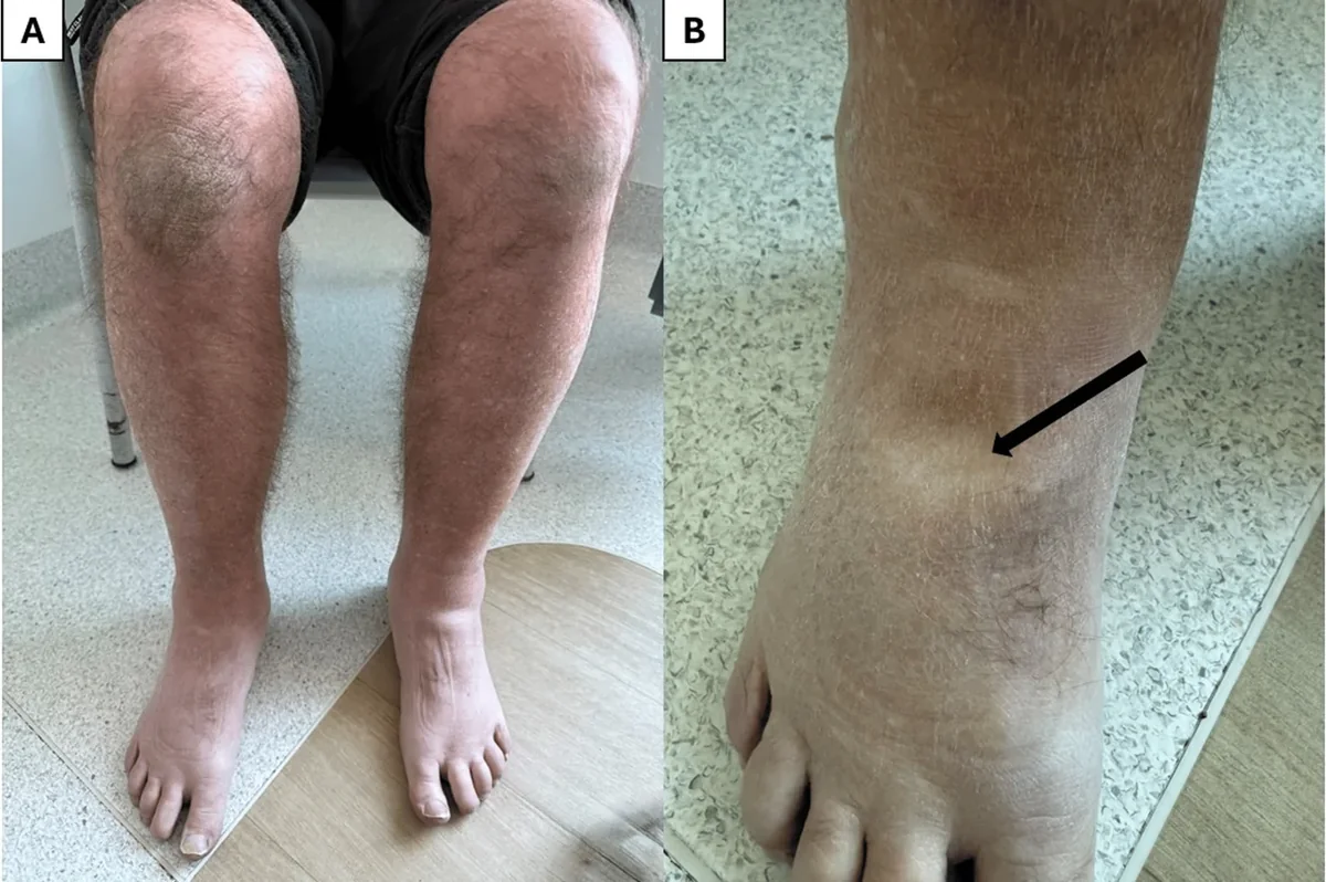 Klinisches Foto: links beidseitige Unterschenkel- und Fußrückenödeme bei einem sitzenden Patienten, rechts eine bleibende Delle am Fußrücken nach Fingerdruck, durch einen Pfeil markiert.
