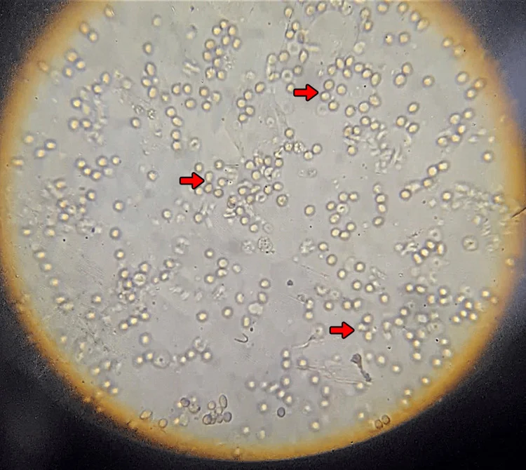 Ungefärbtes Urinsediment unter dem Mikroskop: zahlreiche Erythrozyten unterschiedlicher Form und Größe, dazwischen einzelne Leukozyten; drei rote Pfeile markieren verformte Erythrozyten.