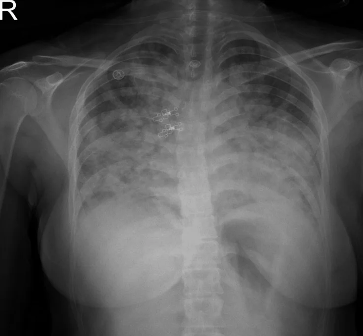 Röntgen-Thorax von vorn: in beiden Lungen ausgedehnte, fleckige bis flächige Verschattungen über fast allen Feldern; Herz nicht vergrößert; oben links die Seitenmarkierung R.
