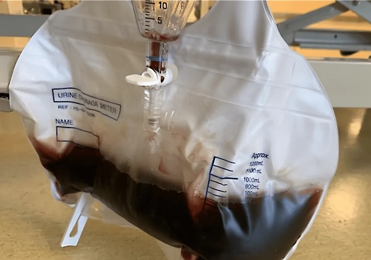 Urinbeutel mit Messkammer neben einem Bett: im Beutel dunkelroter bis fast schwarzer Urin, etwa 900 ml; das Namensfeld ist leer.