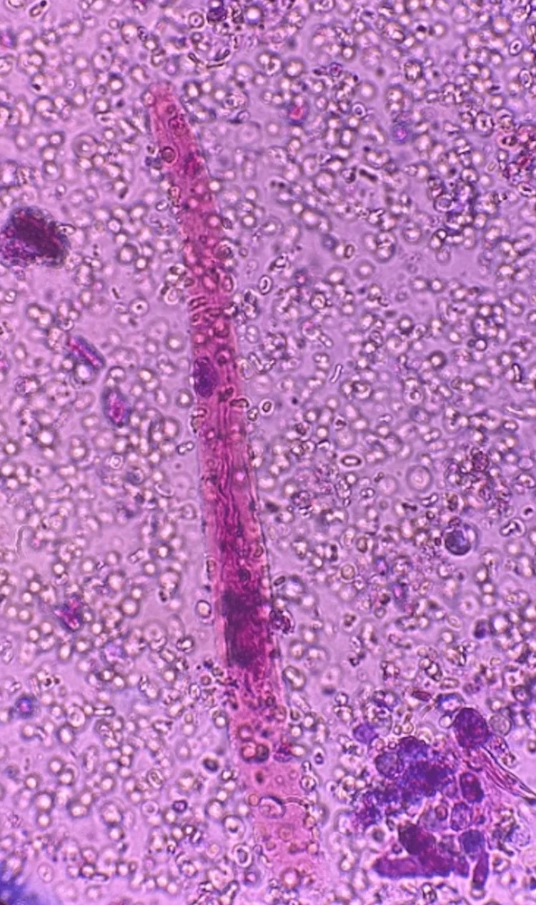 Gefärbtes Urinsediment im Hellfeld: ein langer, schmaler zylindrischer Abguss, in dem dicht gepackte Erythrozyten liegen; ringsum zahlreiche freie Erythrozyten und einzelne Zellhaufen.