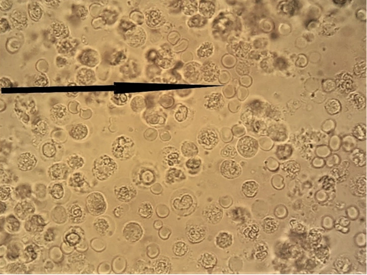 Urinsediment im Hellfeld mit vielen körnigen Leukozyten und kleineren runden Zellen; ein Pfeil zeigt auf eine Gruppe runder Zellen