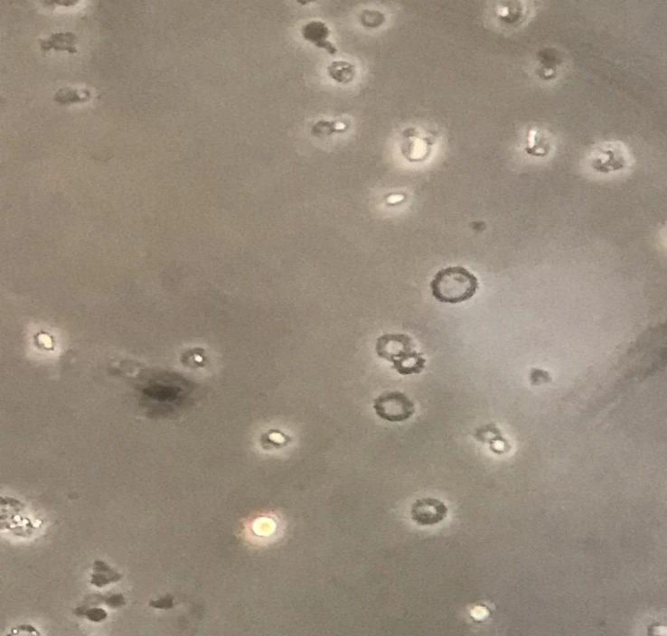 Urinsediment im Phasenkontrast mit mehreren hellen und dunklen Zellen auf grauem Hintergrund