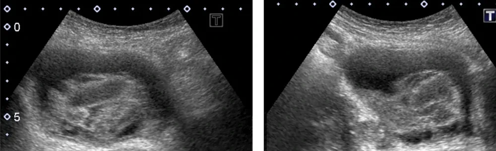 Zwei Ultraschallbilder der Harnblase quer und längs: die Blase ist fast vollständig mit inhomogenem, echoreichem Material gefüllt
