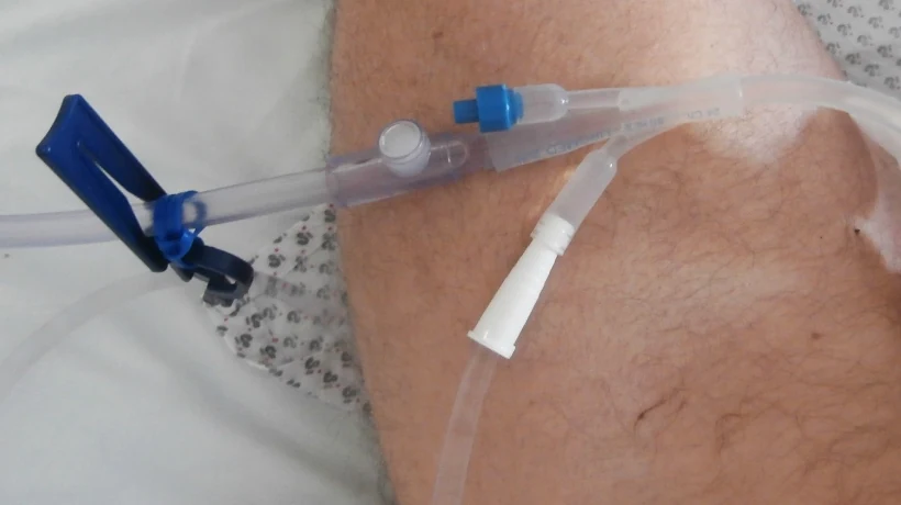 Liegender transurethraler Katheter mit verzweigtem Ansatz: ein Ablaufschlauch, ein weißer Spülanschluss und ein blaues Ballonventil auf dem Oberschenkel