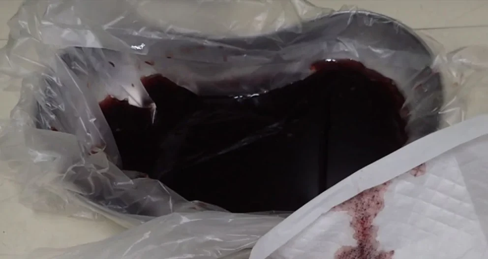 Plastikbeutel in einer Schale mit einer großen Menge dunkelroter, geronnener Blutkoagel