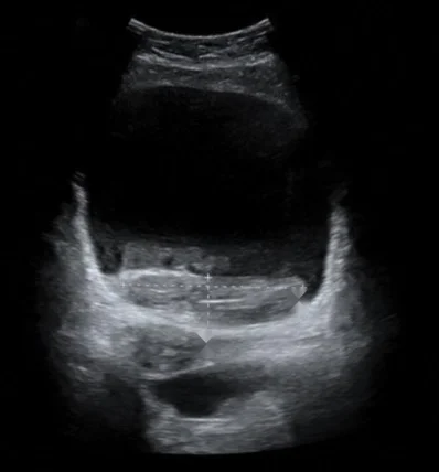 Transabdominale Sonografie des Unterbauchs im Querschnitt: gefüllte Harnblase mit echofreiem Inhalt oben und einer breiten, echoreichen, inhomogenen Schicht am Blasenboden