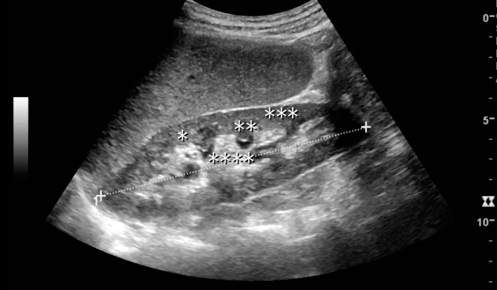 Sonografie einer normalen Niere im Längsschnitt, darüber die Leber; Sternmarkierungen an Bertin-Säule, Markpyramide, Rinde und zentralem Sinus, eine gepunktete Messlinie entlang der Längsachse
