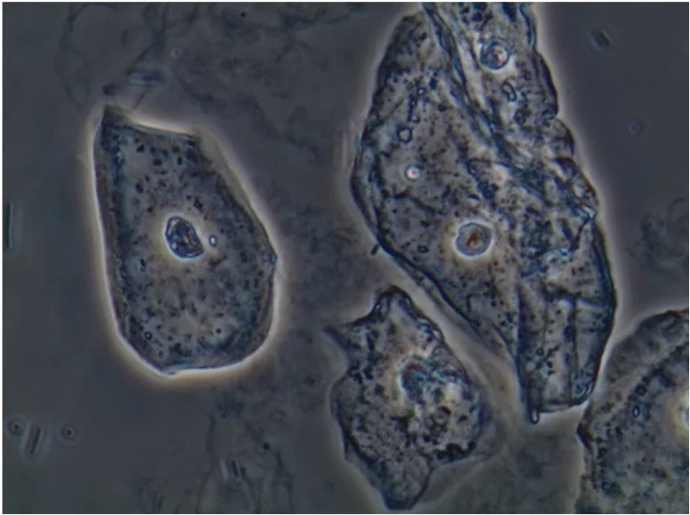 Ungefärbtes Urinsediment im Phasenkontrast mit mehreren großen, flachen, unregelmäßig begrenzten Zellen mit kleinem rundem Kern; im Hintergrund kleine stäbchenförmige Partikel