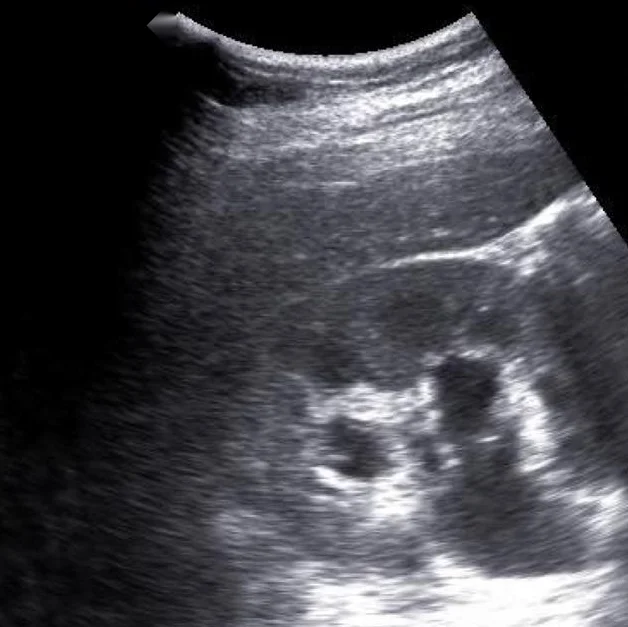 Sonografie einer rechten Niere im Längsschnitt unter der Leber; im Nierenzentrum mehrere rundliche, echofreie, miteinander verbundene Areale