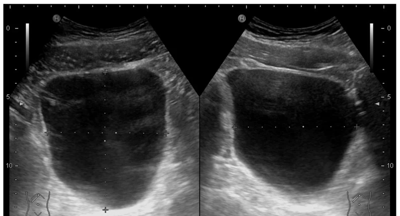Sonografie einer gefüllten Harnblase im Quer- und Längsschnitt mit Messpunkten