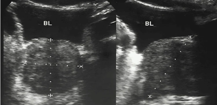 Sonografie mit großer, gleichmäßig echogener Prostata unterhalb der Blase im Quer- und Längsschnitt