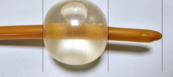 Foley-Katheter mit gefülltem, durchsichtigem Ballon kurz vor der Katheterspitze mit Auge