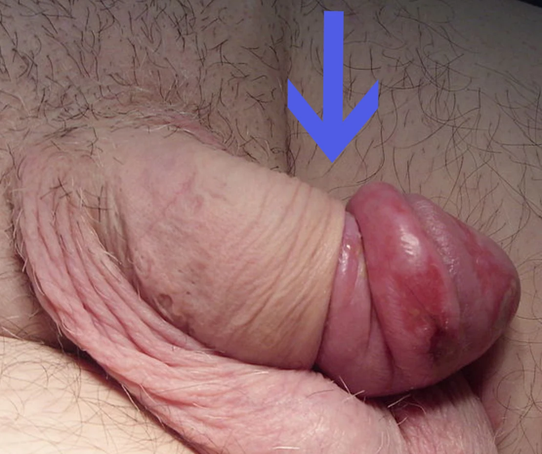 Penis mit zurückgezogener, ringförmig einschnürender Vorhaut und geschwollener, geröteter Eichel, blauer Pfeil