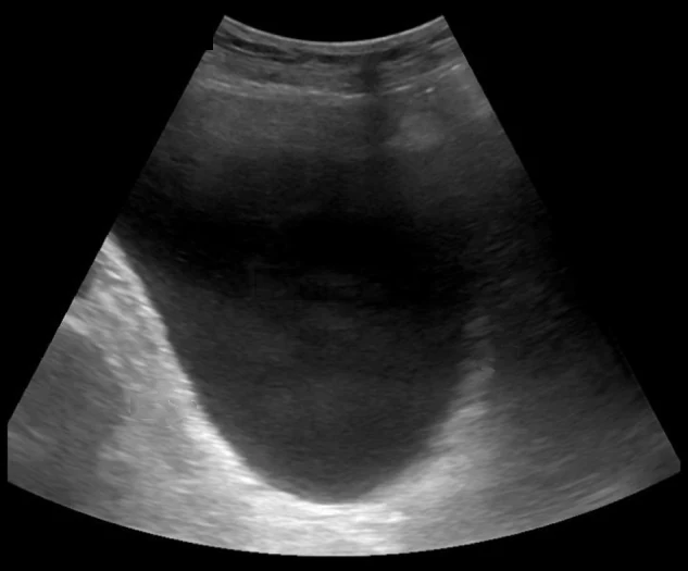 Transabdominale Sonografie des Unterbauchs im Querschnitt