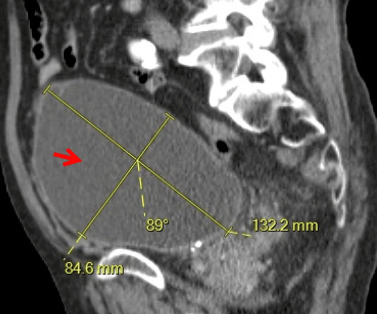 Sagittale CT des Beckens mit stark gefüllter, ovaler Harnblase oberhalb der Symphyse, Messlinien eingezeichnet