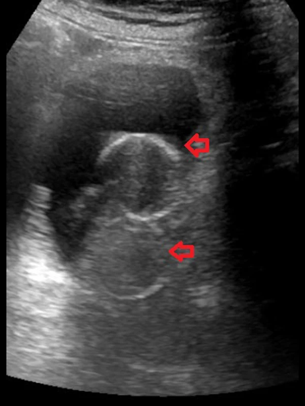 Sonografie der Blase mit zwei runden, ringförmigen Echos im Blasenlumen, rote Pfeile