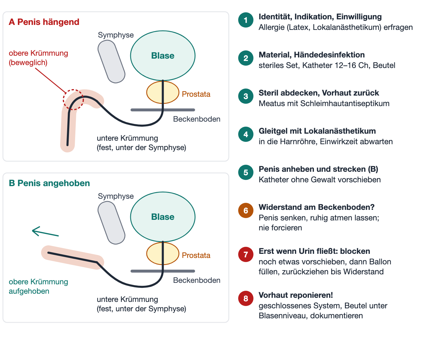 Schematische Darstellung der männlichen Harnröhre mit zwei Krümmungen, links nummerierte Schritte der Katheteranlage