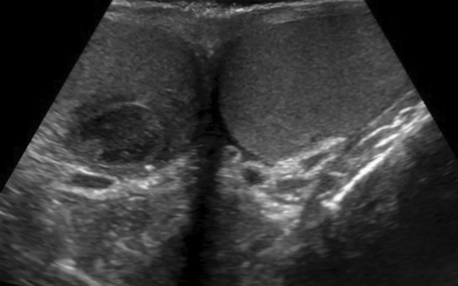 Hodensonografie im Querschnitt durch beide Hoden: im links abgebildeten rechten Hoden eine ovale, scharf begrenzte, deutlich dunklere Läsion; der rechts abgebildete linke Hoden ist gleichmäßig grau