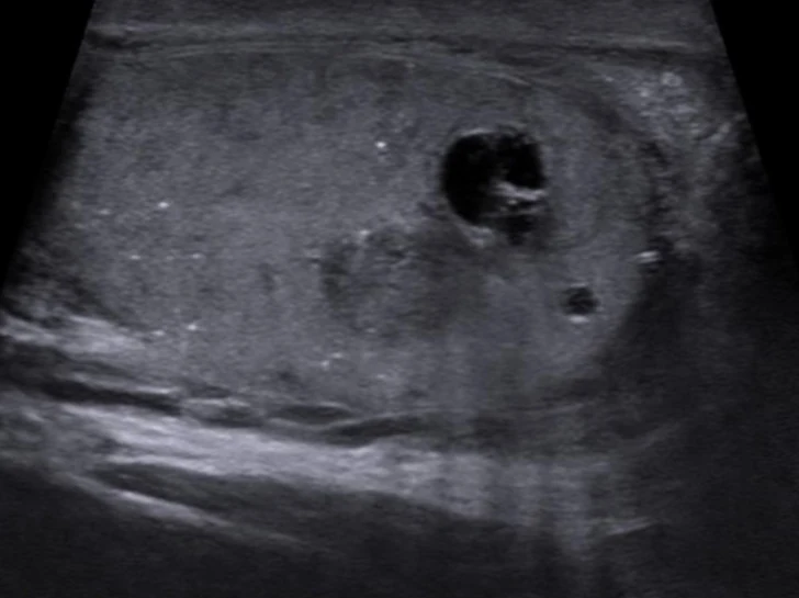 Hodensonografie im Längsschnitt: Hoden mit einer unscharf begrenzten Zone, in der eine runde echofreie Zyste mit innerer Struktur, eine zweite kleine Zyste und mehrere helle Punkte liegen