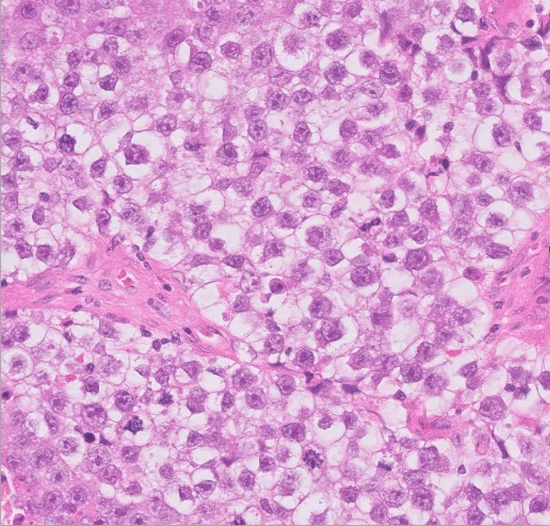 Lichtmikroskopisches Bild, Hämatoxylin-Eosin-Färbung: dicht gelagerte große runde Zellen mit hellem Zytoplasma, deutlichen Zellgrenzen und großen Kernen; dazwischen schmale rosa Bindegewebsstränge mit kleinen dunklen Zellen