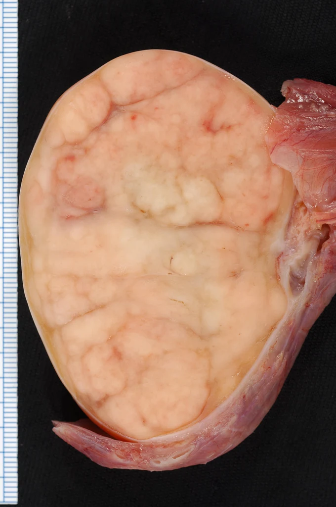 Aufgeschnittener Hoden auf dunklem Untergrund neben einem Maßstab: das Organ ist fast vollständig von einem cremefarbenen, gelappten, weichen Gewebe ersetzt, am Rand ein schmaler Saum mit anhängendem Samenstranggewebe