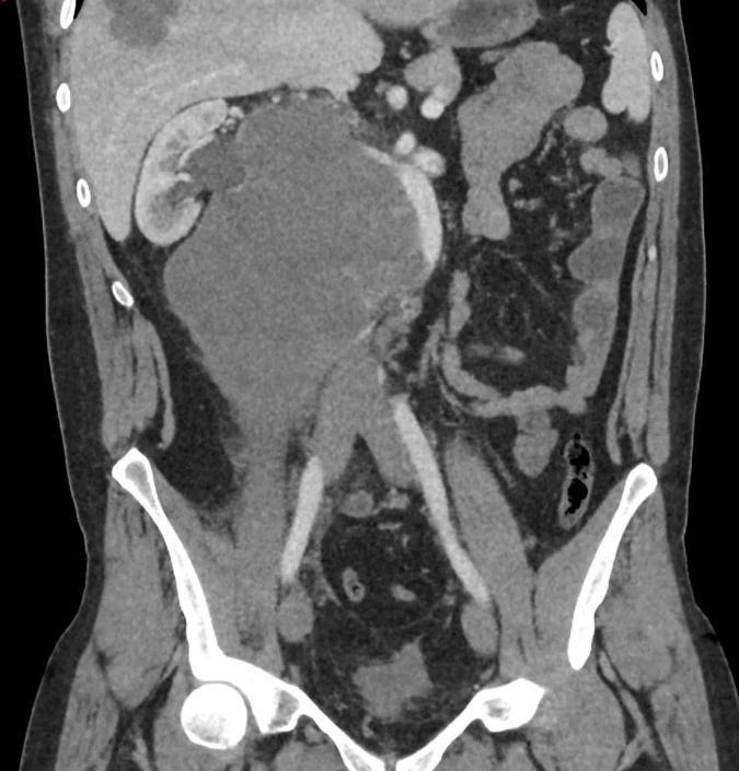 Koronares Kontrastmittel-CT des Abdomens: große, gleichmäßig weichteildichte Raumforderung im rechten Retroperitoneum, die von der Nierengefäßhöhe bis zum Becken reicht, die Aorta zur Seite drängt und die rechte Niere aufstaut