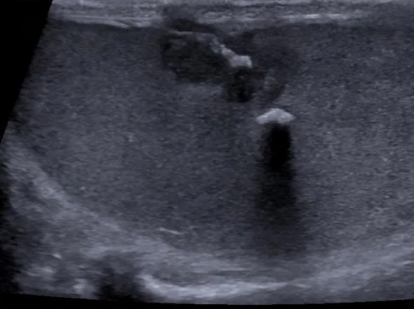 Hodensonografie im Längsschnitt mit einer unregelmäßigen Struktur am oberen Rand des Organs und einem hellen Reflex mit dunklem Schatten darunter