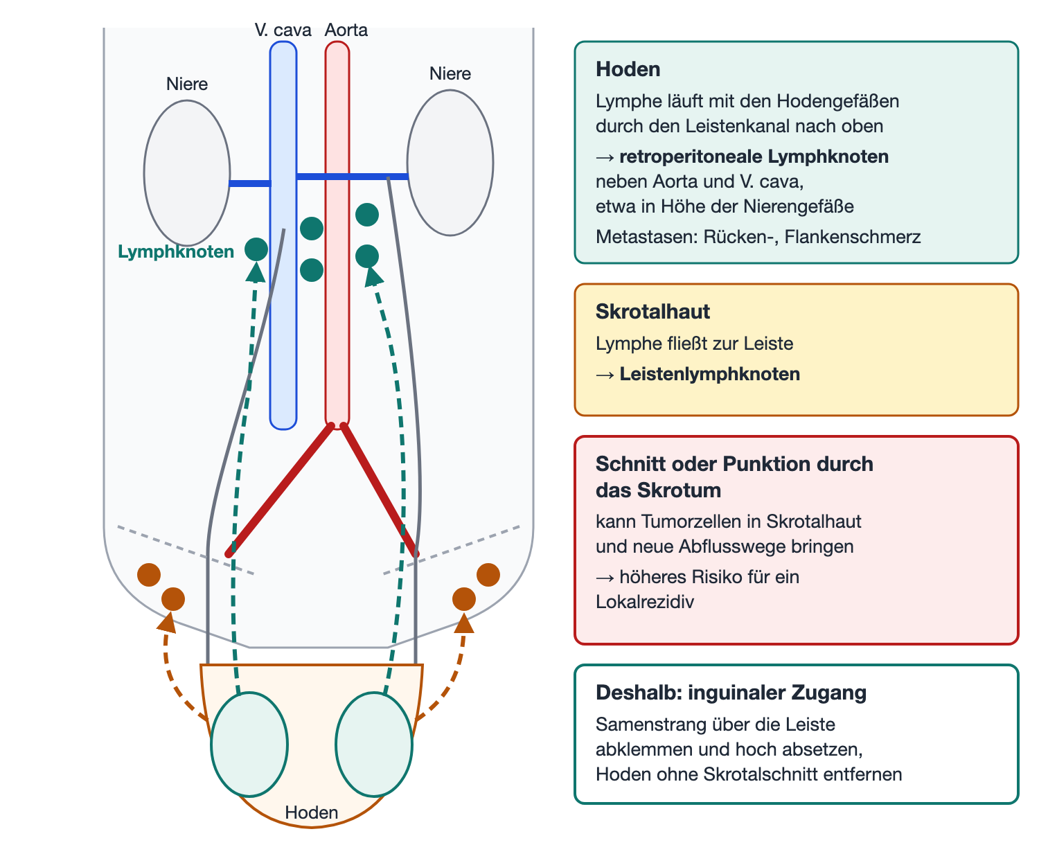 Schema des Retroperitoneums mit Nieren, Aorta und V. cava: Lymphwege beider Hoden ziehen gestrichelt nach oben zu Lymphknoten neben Aorta und V. cava in Höhe der Nierengefäße, die Lymphe der Skrotalhaut fließt zu den Leistenlymphknoten; rechts Erklärkästen zu Hoden, Skrotalhaut, skrotalem Eingriff und inguinalem Zugang