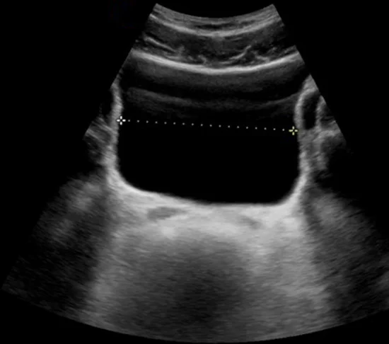 Transabdominale Sonografie des Unterbauchs im Querschnitt mit einer echofreien, glatt begrenzten Harnblase und einer gepunkteten Messlinie quer durch die Blase