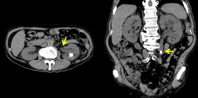 Natives CT des Abdomens axial und koronar; ein sehr heller Herd im linken Harnleiter ist mit gelben Pfeilen markiert, oberhalb davon ist das linke Nierenbecken erweitert