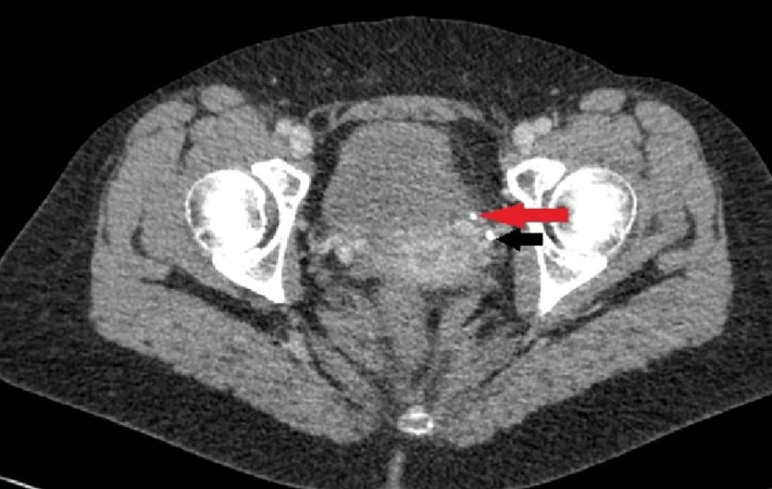 Axiales CT des Beckens mit zwei kleinen, hellen Herden links an der Blasenwand, markiert durch einen roten und einen schwarzen Pfeil