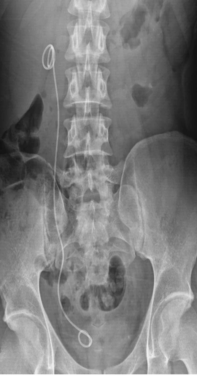 Röntgen-Übersichtsaufnahme des Abdomens mit einem dünnen, röntgendichten Schlauch rechts, dessen Ringende im Nierenbecken und dessen zweites Ringende in der Blase liegt