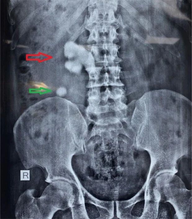 Röntgen-Übersichtsaufnahme des Abdomens mit einem großen, dichten Konkrement in Projektion auf das rechte Nierenbecken und einem kleineren Konkrement darunter