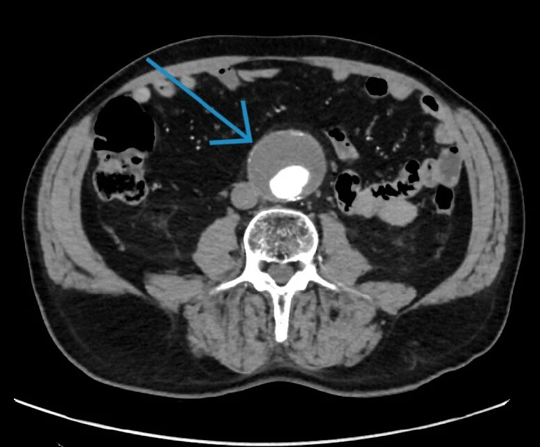 Axiales CT mit Kontrastmittel: deutlich erweiterte Bauchaorta mit wandständigem Thrombus vor der Wirbelsäule, durch einen blauen Pfeil markiert