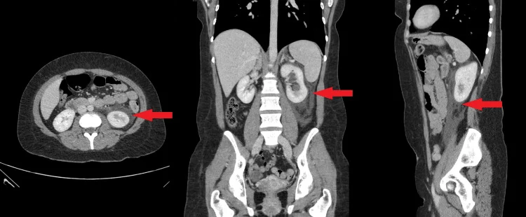 CT des Abdomens in drei Ebenen mit Flüssigkeitssaum und entzündlich verdichtetem Fettgewebe um die linke Niere, durch rote Pfeile markiert
