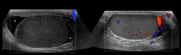 Farbdopplersonografie beider Hoden im Längsschnitt nebeneinander: links ein Hoden ohne Farbsignale im Gewebe und mit Flüssigkeitssaum, rechts ein Hoden mit verteilten roten und blauen Farbsignalen