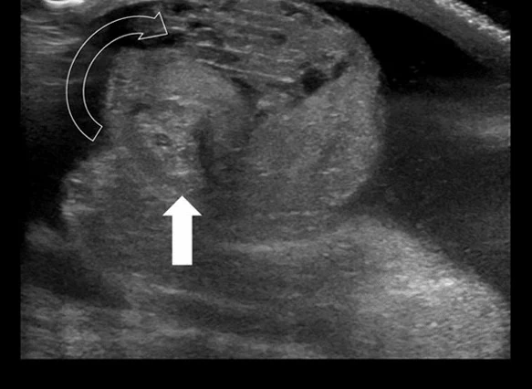 Graustufen-Ultraschall des oberen Skrotums: der Samenstrang bildet eine kreisförmig gewundene Struktur, markiert mit einem gebogenen Pfeil und einem weißen Pfeil