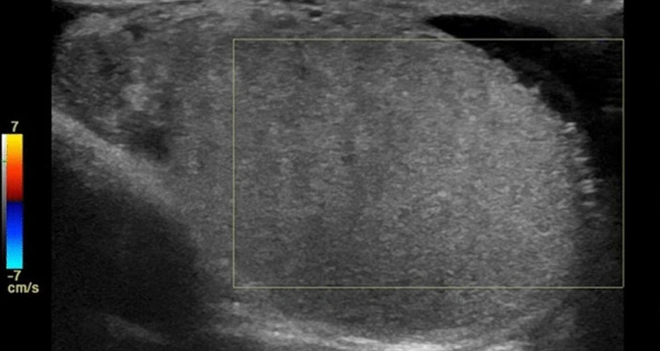 Farbdopplersonografie eines Hodens im Längsschnitt mit rechteckigem Farbfenster über dem Hodengewebe