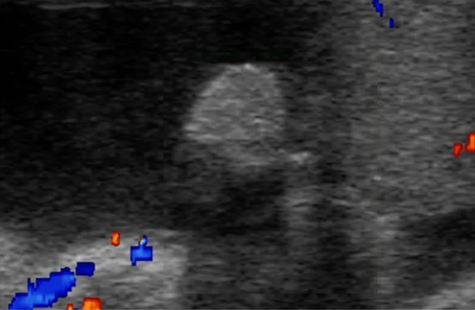 Farbdopplersonografie: kleine, runde, echoreiche Struktur ohne Farbsignal; einzelne Farbsignale nur am Bildrand