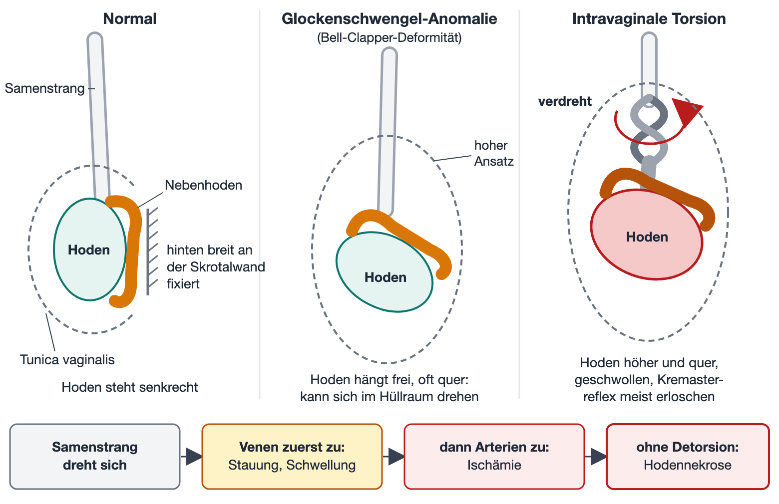 Drei Schemazeichnungen: normal fixierter Hoden, frei hängender Hoden bei Glockenschwengel-Anomalie und verdrehter Samenstrang mit geschwollenem, quer stehendem Hoden; darunter eine Ereigniskette von der Drehung bis zur Nekrose